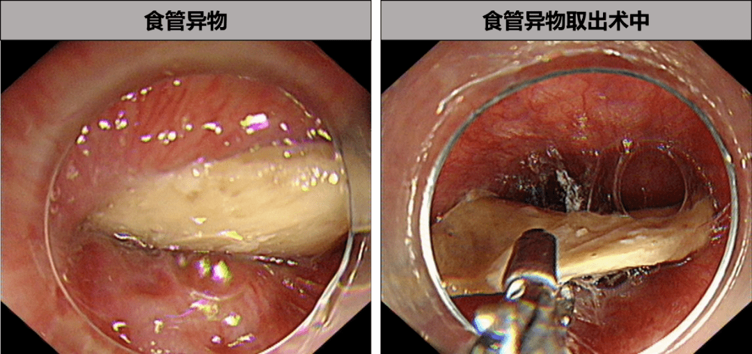 小异物,大"难题",省中医院消化内镜中心来帮忙_食管