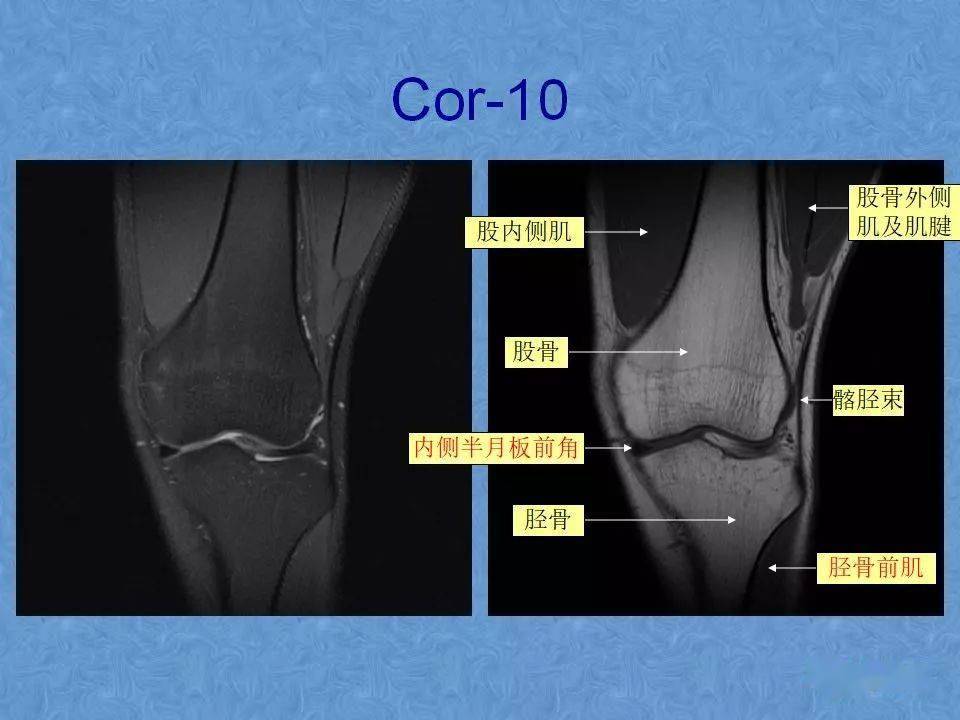 70张膝关节mri高清解剖图解推荐收藏