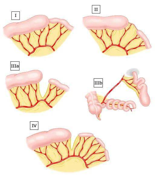 肠闭锁图片