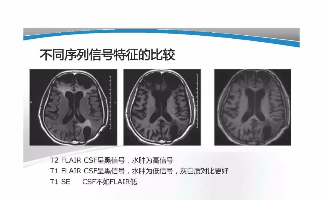 t2 flair序列图片