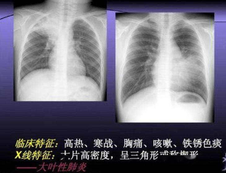 怎么才能得肺炎 10ad48de9151404fb6567d22a1acb993.jpeg