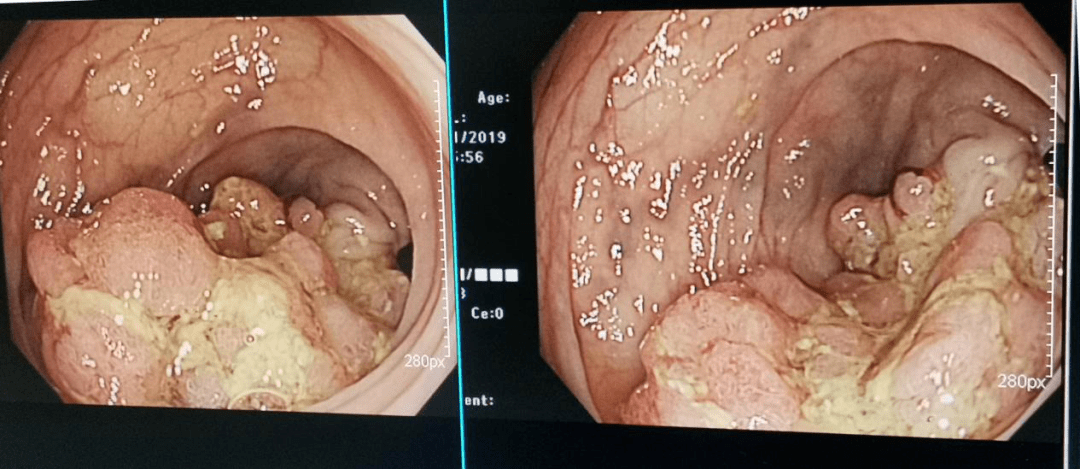 结肠中分化腺癌图片