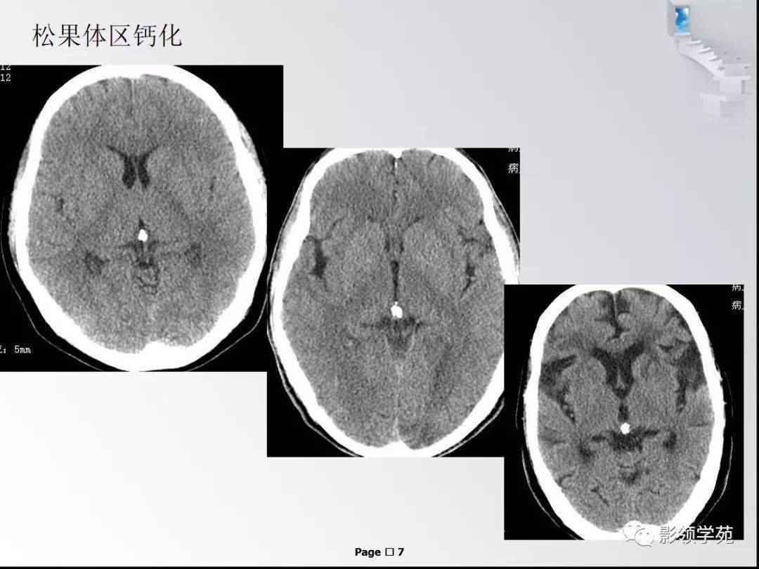 Ⅱ度:ct明显钙化,平片无异常所见;i度:仅ct发现钙化;松果体区钙化分四