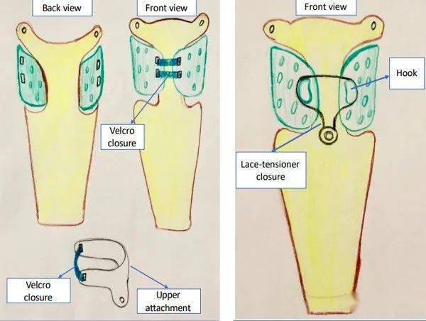 大学生开发出3d打印假肢上肢接受腔只需30欧元