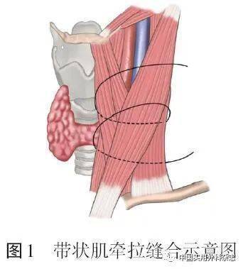 专家共识腔镜甲状腺手术缝合技术与缝合材料选择中国专家共识2021版