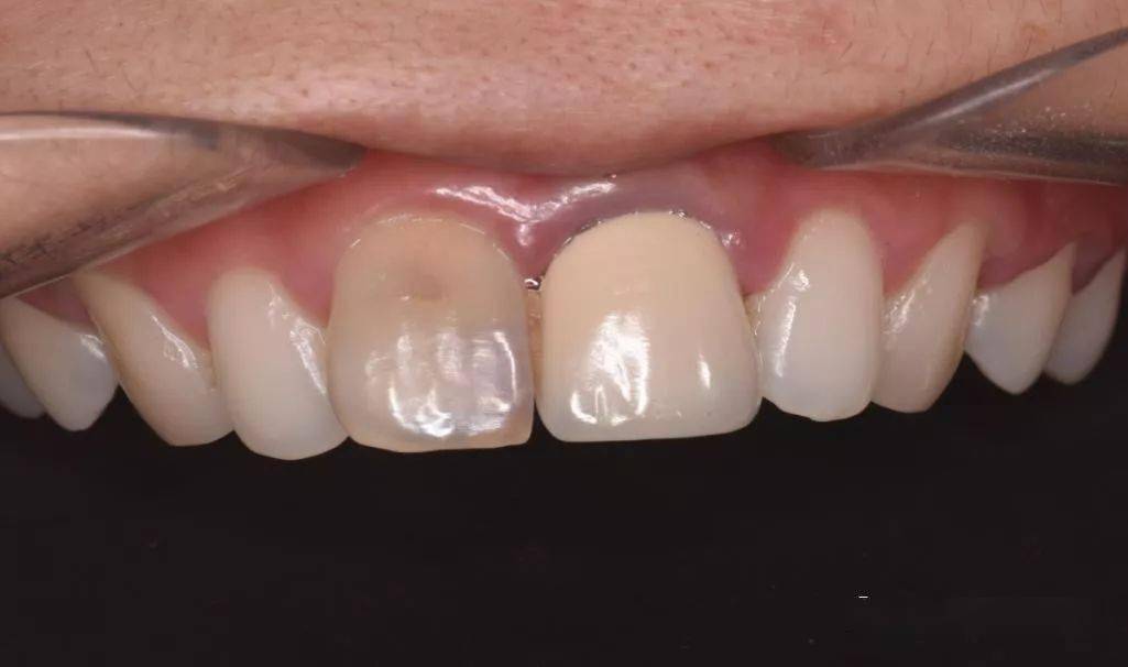 口腔检查:口腔卫生状况一般,11牙冠变色,近中邻面见齿色填充物,舌侧窝