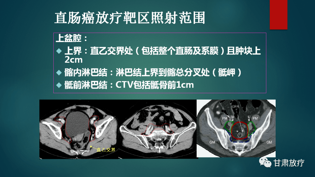 精品课件 直肠癌的靶区勾画_放疗