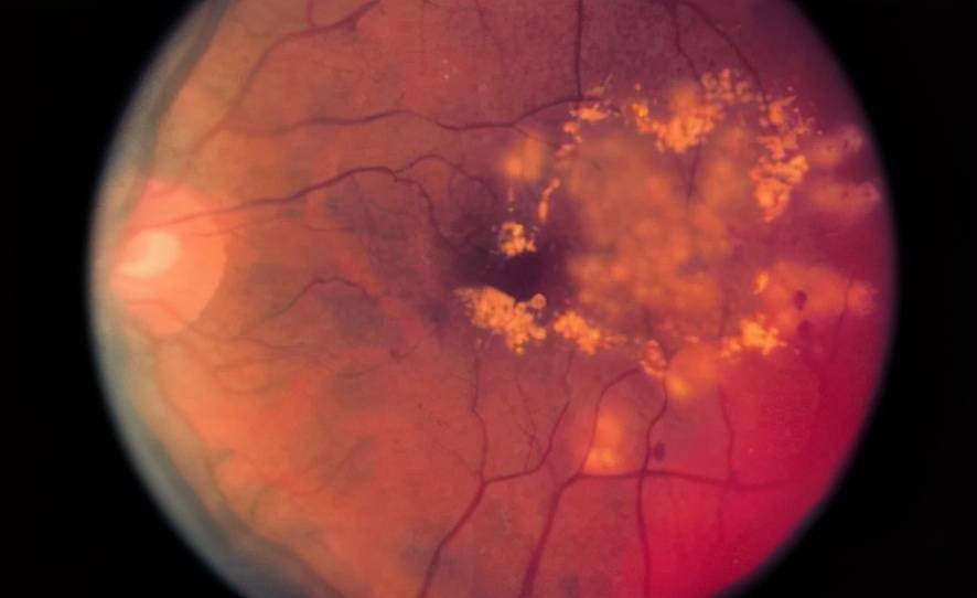 症状就已经是比较晚期了,因此眼底照片可以帮我们做到眼病的早筛查,早