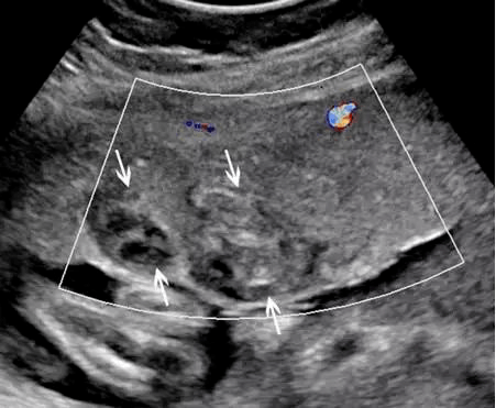 多图前置胎盘胎盘早剥9种胎盘异常的超声解读