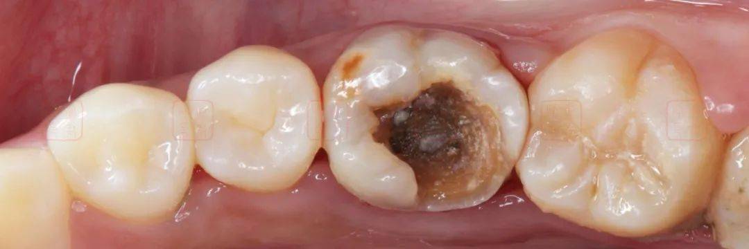 松风病例秀f00制作覆盖体磨牙大面积缺损的椅旁间接修复