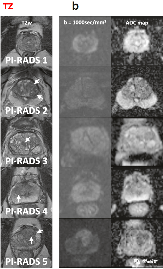 PI-RADS 前列腺影像报告和数据系统_诊断