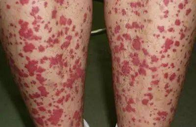 的血管变态反应性的皮肤黏膜出血性疾病,皮肤出血点常见于四肢及臀部