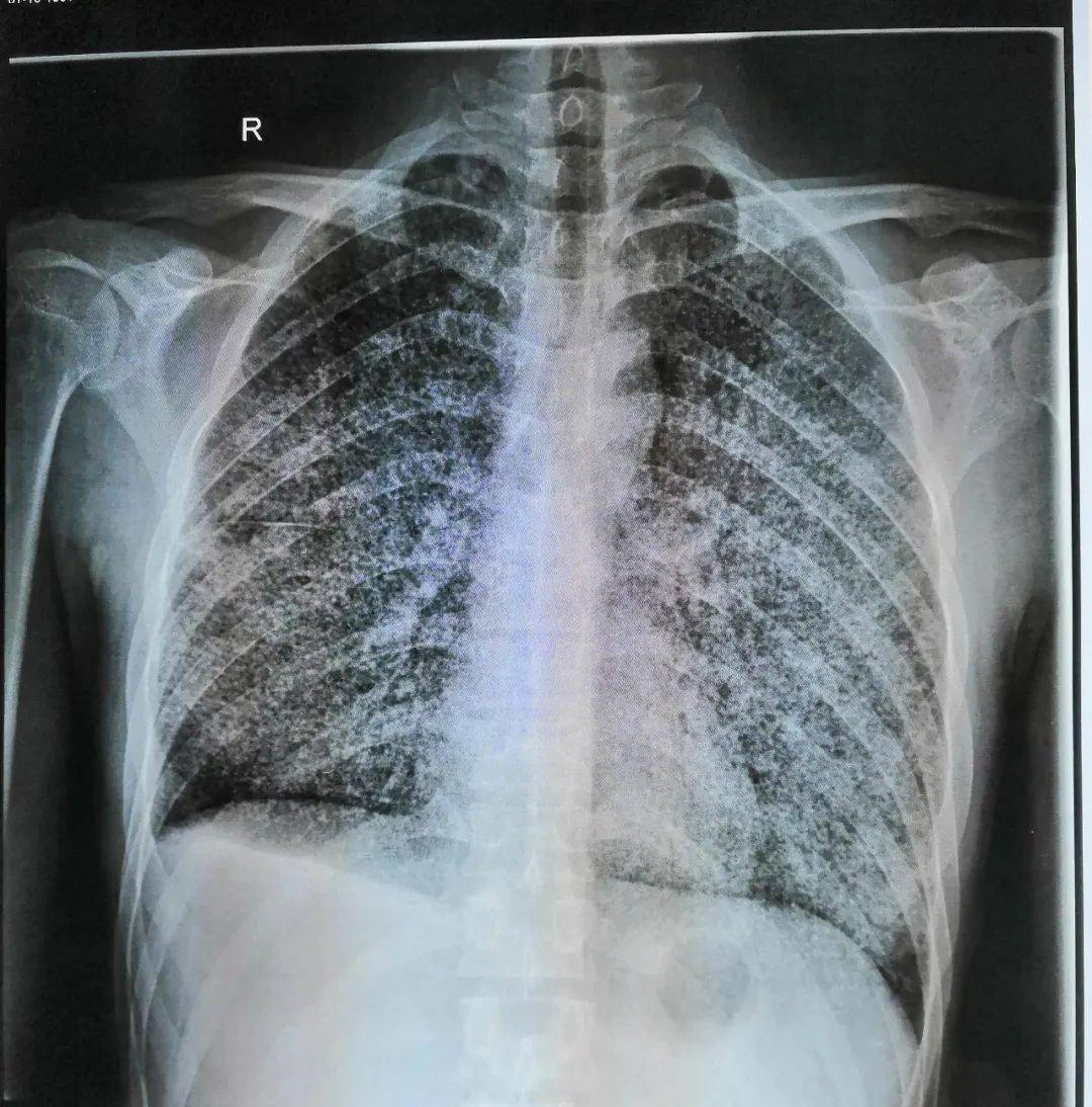 后续查了个 ct 如下