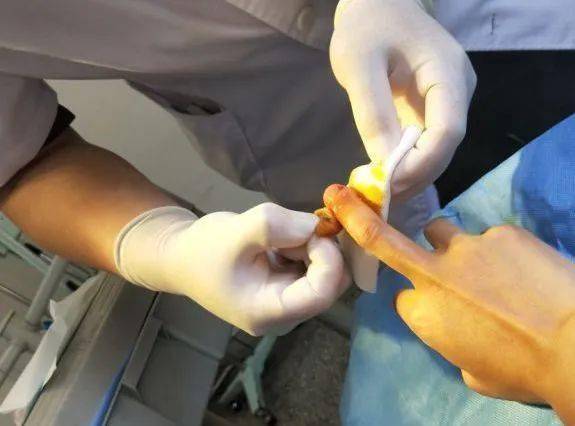 撕过手上倒刺的请举手撕完后居然可能面临截肢