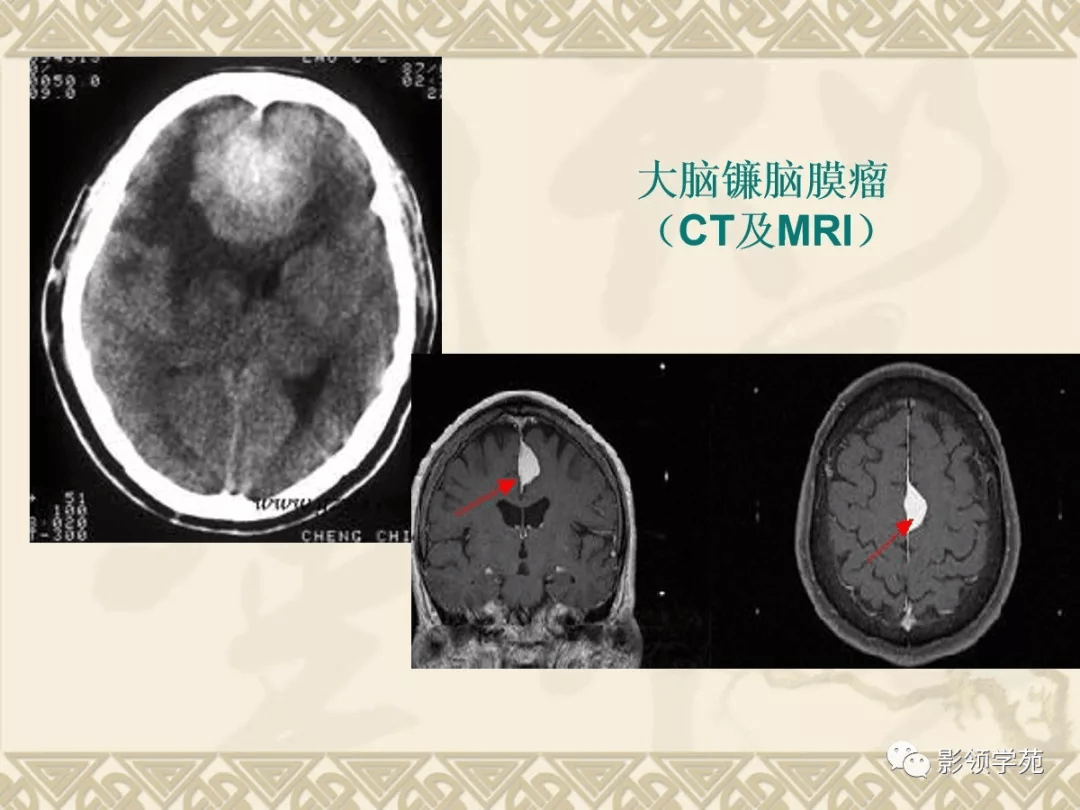 常见脑肿瘤的影像诊断