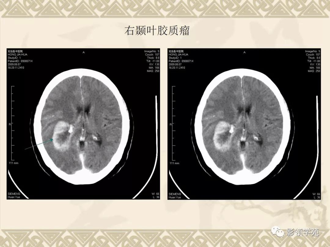 常見腦腫瘤的影像診斷