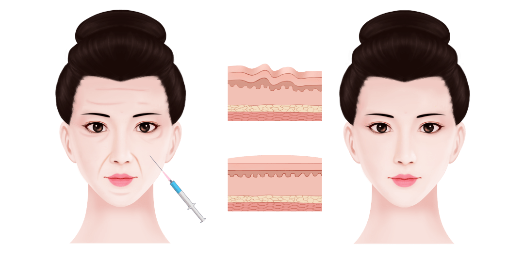 关于除皱针你知道多少