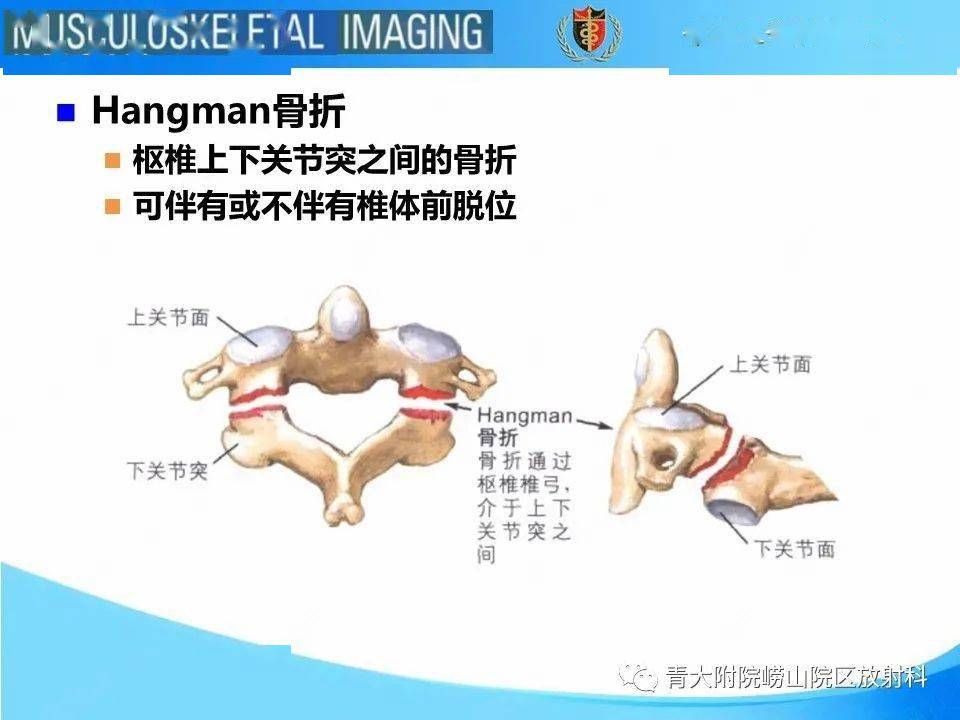 jefferson骨折_放射科