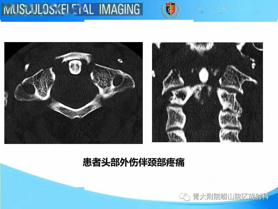 jefferson骨折_放射科