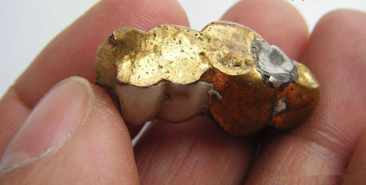 农村不让带金属下葬,老一辈选择火葬或土葬,镶的金牙怎么处理?