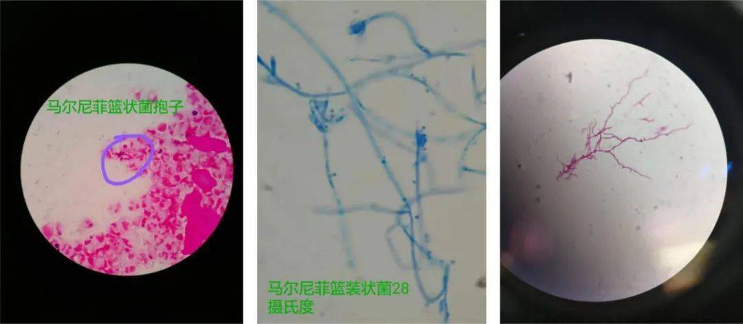 马尔尼菲篮状菌肺炎图片