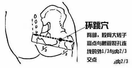 位置:股骨大轉子和骶管裂孔連線的外三分之一處.