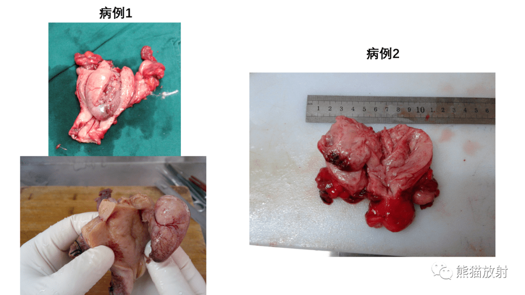 子宫内膜间质肉瘤,息肉样腺肌瘤你想到了吗?有收获吗?