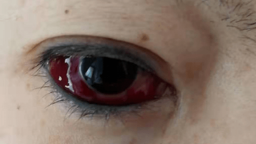 出院后半月,患者出现右眼球结膜充血并伴有颅内吹风样杂音,眼球活动