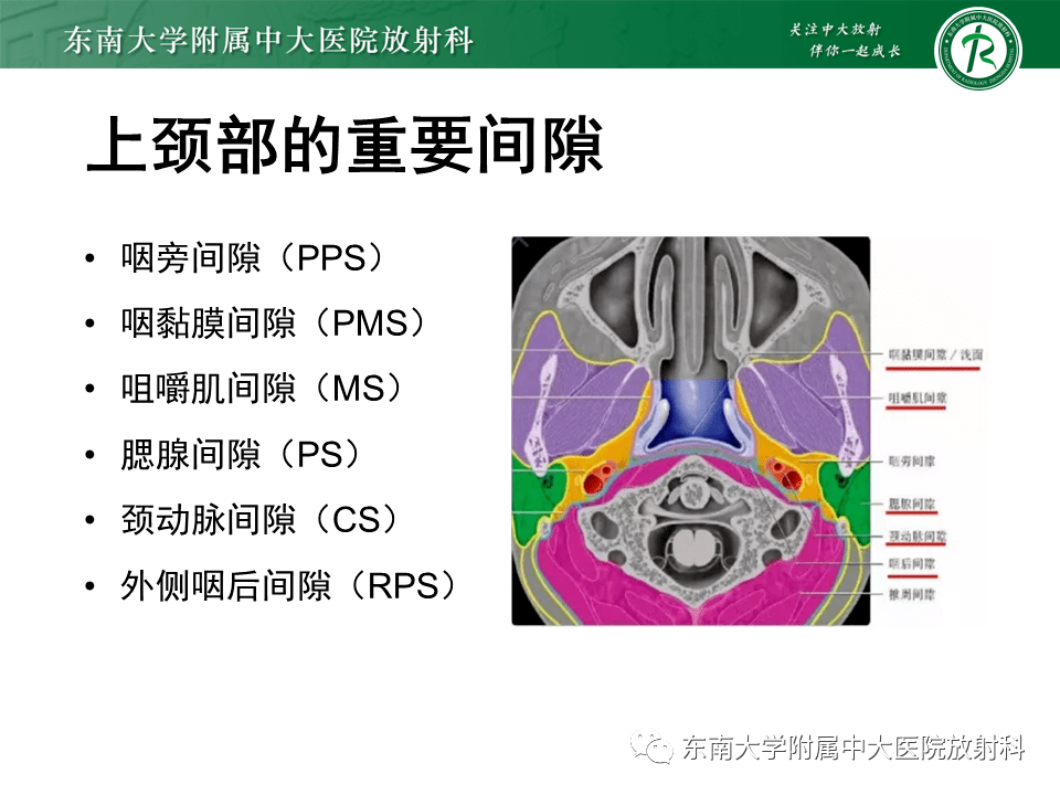 鼻咽部未窥清无明显不适,入院检查发现左侧咽旁间隙占位男,47岁