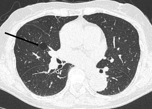 胸部ct扫描可以偶然发现一个孤立的囊肿或几个小的肺囊肿