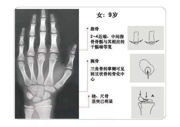 收藏必備丨骨齡圖譜修正版