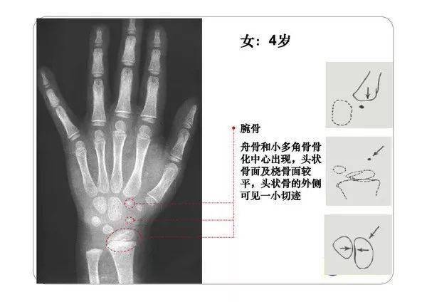 收藏必备丨骨龄图谱修正版