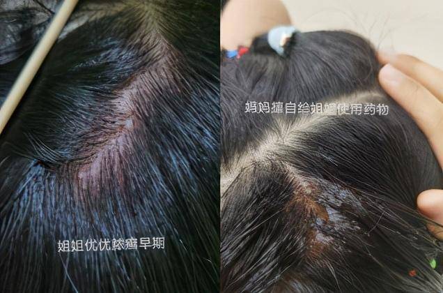 而且头皮出现很多脓包块,疼痛厉害,不断流脓,反复发高烧,还脱头发,就