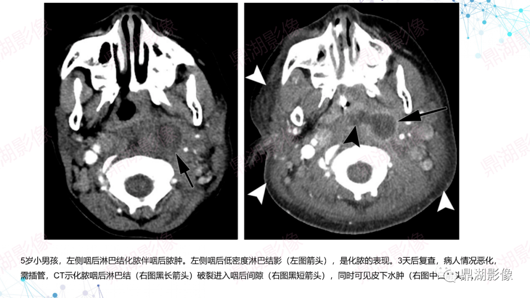 扁桃體炎影像表現會厭炎影像表現右側惡性外耳道炎影像表現閱片的基礎