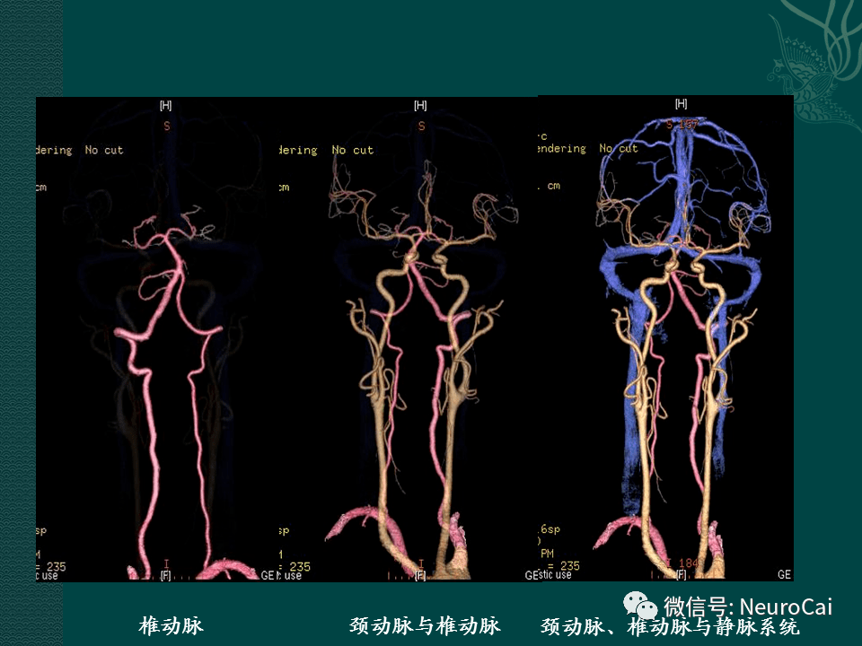 高清圖腦動脈解剖與ct重建