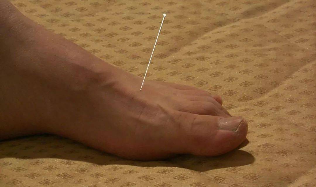 醒脑三针,调理中风