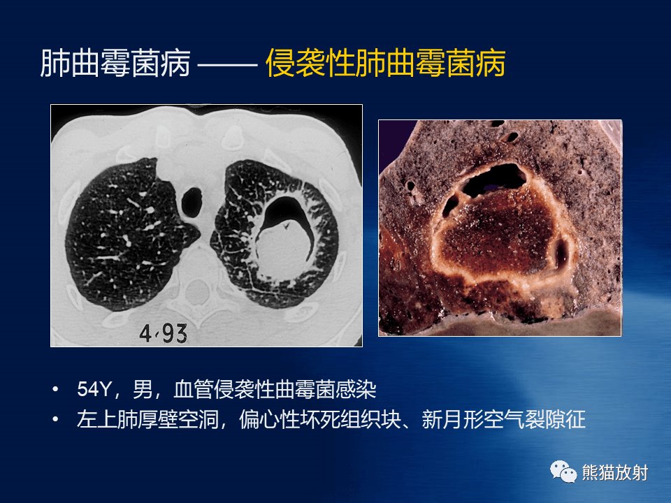 肺真菌病丨影像學表現與病理對照