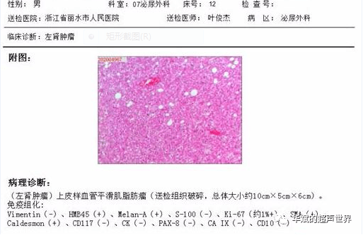 典型病例61肾上皮样血管平滑肌脂肪瘤