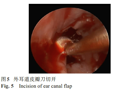 鎢針電刀在耳內鏡鼓膜修補手術中的應用