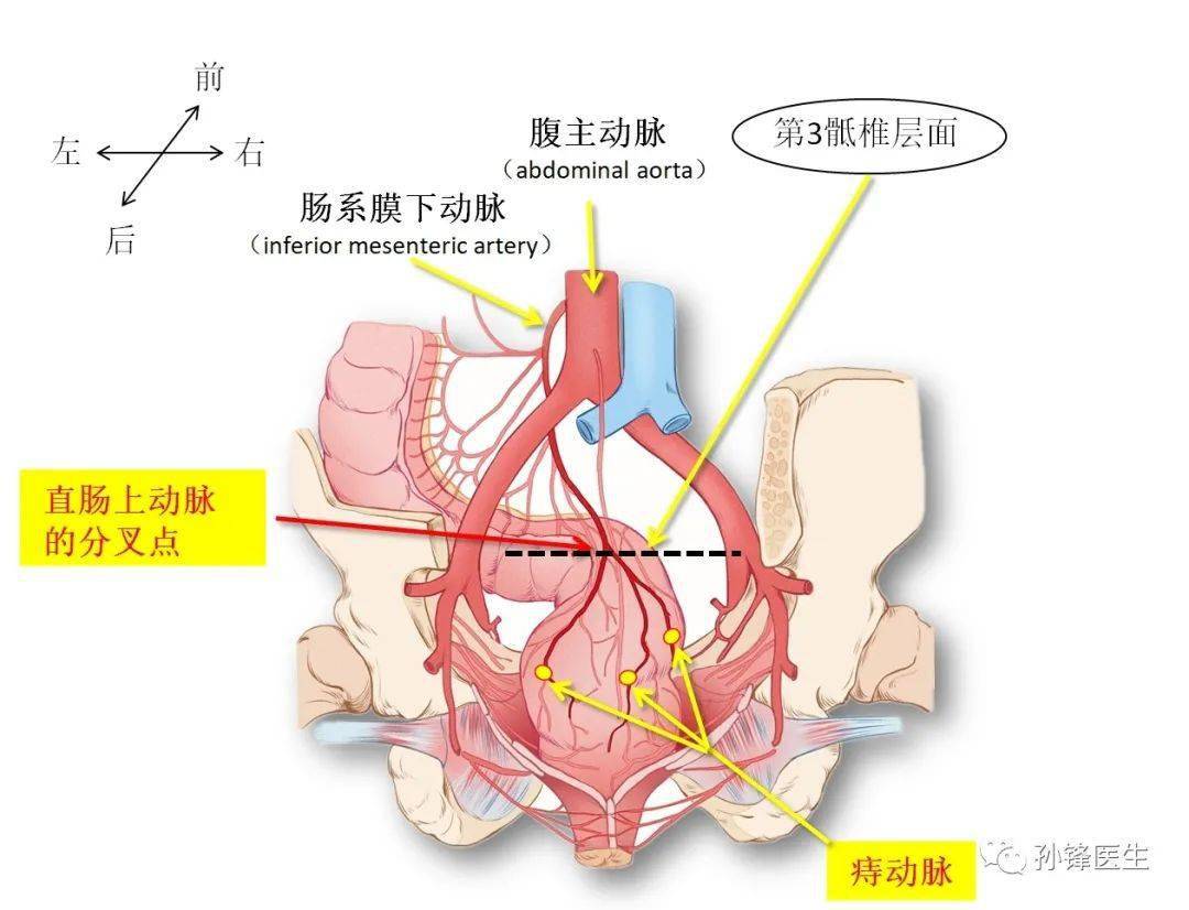 手术笔记痔的星月术弧形直肠粘膜环切术痔动脉结扎术