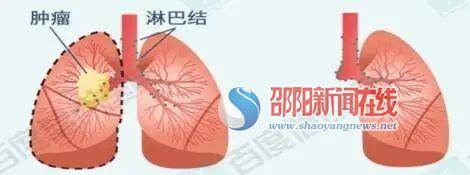 细胞|邵阳市中心医院心胸外科成功完成一例高难度肺癌根治术