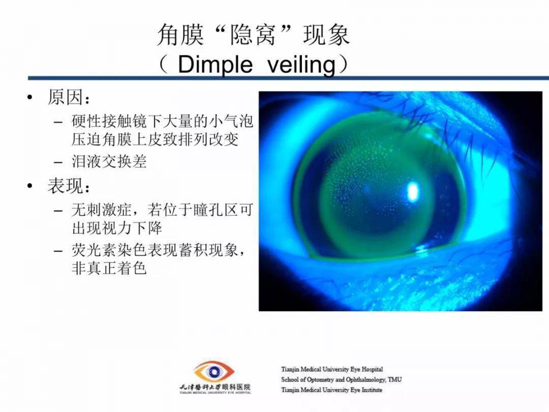 【眼视光】塑形镜相关并发症原因及处理_角膜