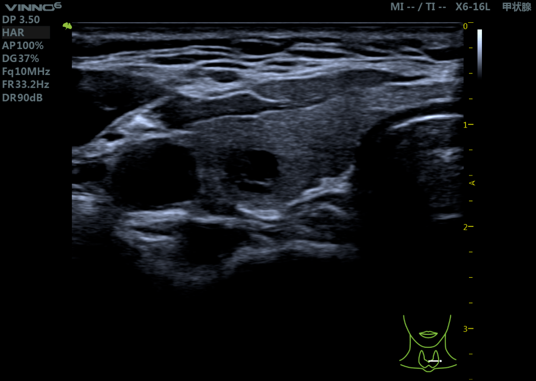 甲状软骨超声图像图片