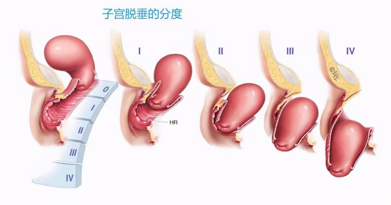 产后直肠膨出图图片