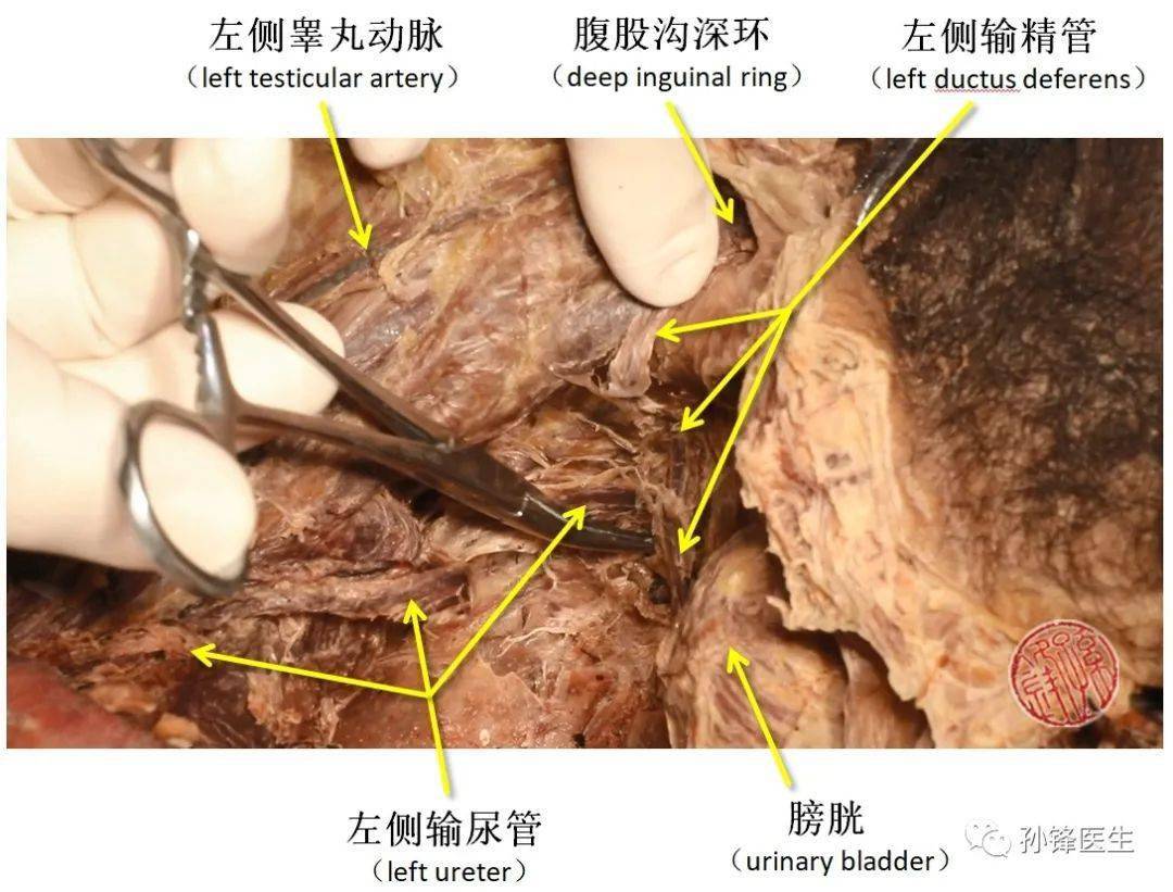 圖(10):左側輸尿管與左側輸精管的交叉點↑↑↑圖(11):左側輸尿管與