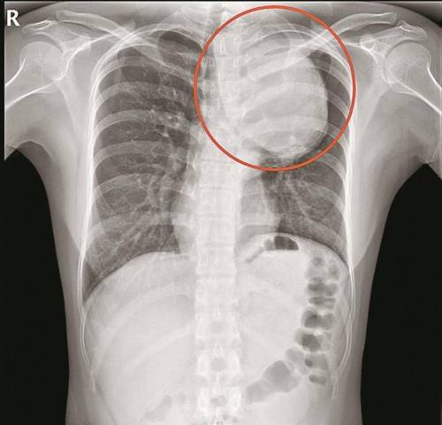 里长|险！主动脉里长出青芒大的瘤