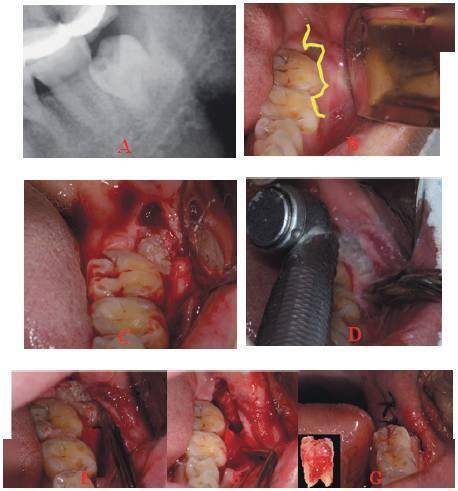 垂直阻生的拔除要点