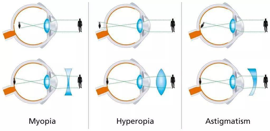 近视,远视,散光成像与矫正