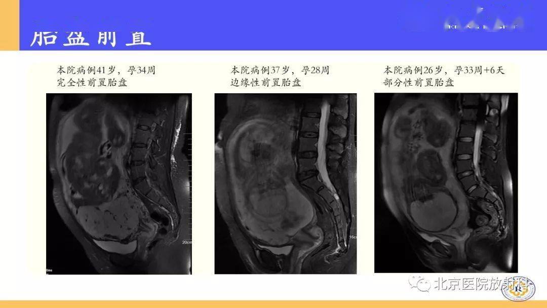 核磁共振胎盘植入图片图片