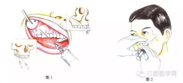 牙周膜麻醉注射方法图片